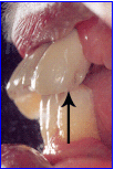 Female dimple prepped onto the enamel Female dimple prepped onto the enamel