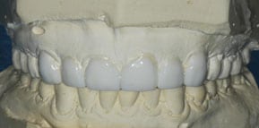Diagnostic Wax-Up Diagnostic Wax-Up