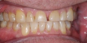 Post Ortho Retracted Post Ortho Retracted