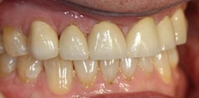 Final All Ceramic Crowns Final All Ceramic Crowns
