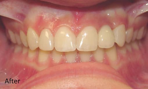 After Cosmetic Restoration After Cosmetic Restoration