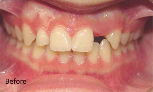 Before Cosmetic Restoration Before Cosmetic Restoration