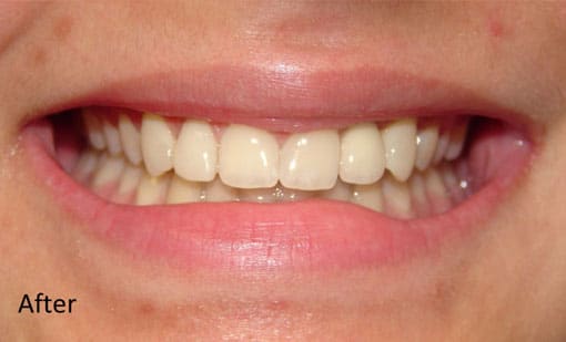 After Cosmetic Restoration After Cosmetic Restoration