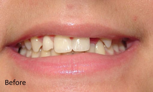 Before Cosmetic Restoration Before Cosmetic Restoration