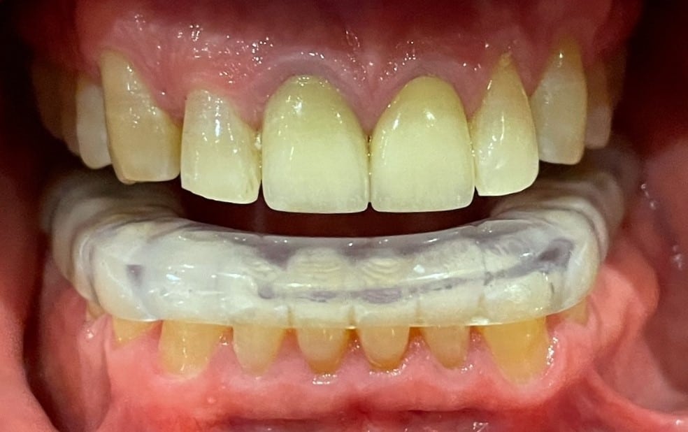 Bruxism Appliance | Klausz Dental Lab